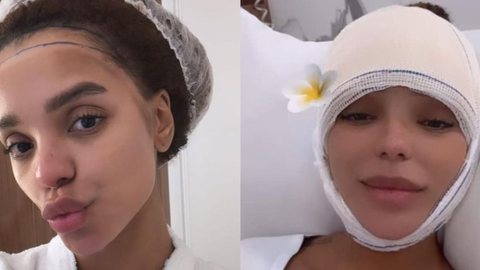 Brunna Gonçalves realiza cirurgia para diminuir a testa - Imagem: Reprodução/ Instagram