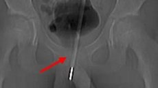 Um adolescente inseriu um termômetro no pênis enquanto se masturbava, que foi visto pelo exame de Raio-X. - Imagem: reprodução I Revista Científica Asian Journal Of Sugery