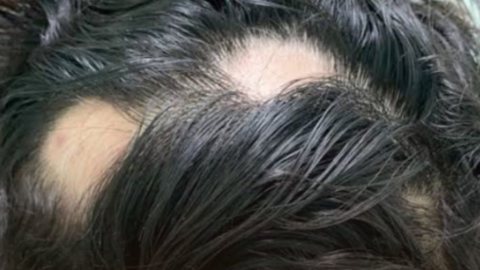 A Alopecia Areata é mais comum em adultos jovens, porém é um susto que ainda pode acontecer com pessoas de qualquer idade, incluindo crianças pequenas - Imagem: Reprodução/Instagram @_alopeciaareata