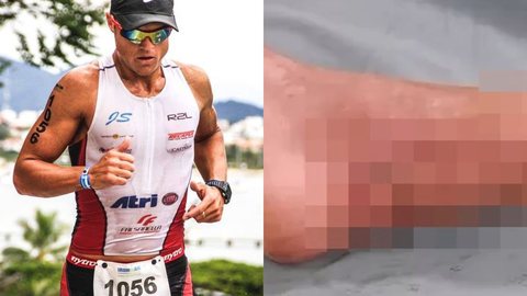 Triatleta passou por três cirurgias após o ataque de mais de 50 mordidas - Imagem: Facebook Tiago Belloube