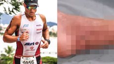 Triatleta passou por três cirurgias após o ataque de mais de 50 mordidas - Imagem: Facebook Tiago Belloube