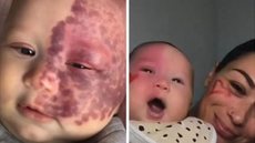 Bebê nasceu com doença rara - Imagem: Instagram @portalr7