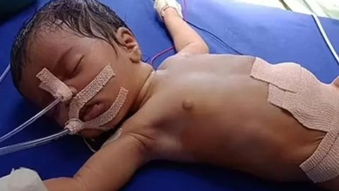 A criança precisou passar por um procedimento cirúrgico de 1h30 - Imagem: reprodução Mail Online Health