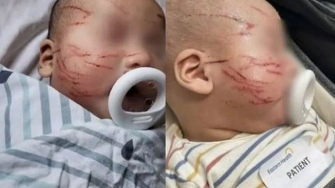 Uma creche na Austrália entregou um bebê de 10 meses para a mãe com o rosto coberto de arranhões, alegando um 'acidente'. - Imagem: reprodução I Extra Online