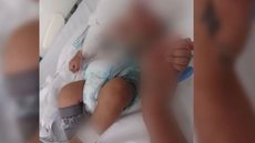Um menino de dois meses foi atingido, suspostamente por um celular, pelo próprio pai, durante uma briga entre ele e a esposa. - Imagem: reprodução I G1