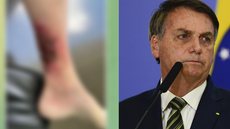 IMAGEM FORTE! Bolsonaro trata erisipela grave na perna e preocupa apoiadores - Imagem: reprodução / Agência Brasil