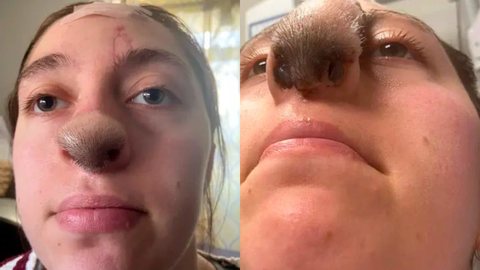 Enfermeira leva mordida de cachorro no nariz e cabelo começa a crescer na região - Imagem: reprodução New York Post