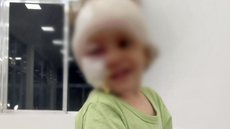 Bebê de um ano e sete meses fica com rosto desconfigurado após ataque de cachorro - Imagem: arquivo pessoal cedido a IstoÉ