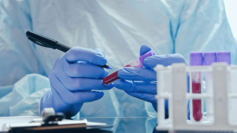 Novo exame de sangue desenvolvido por cientistas brasileiros pode ajudar na detecção precoce do câncer de mama com alta precisão - Imagem: Reprodução
