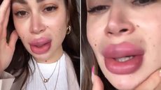 Carol Narizinho aparece com a boca inchada - Foto: Reprodução / Instagram