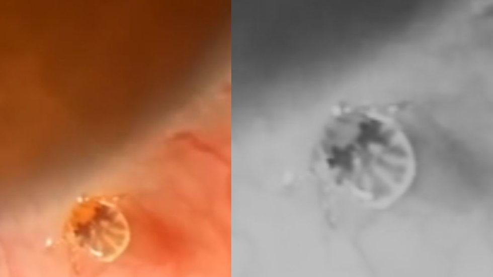 Oftalmolista encontrou carrapato vivo em olho de paciente - Imagem: reprodução Tiktok