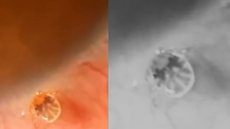 Oftalmolista encontrou carrapato vivo em olho de paciente - Imagem: reprodução Tiktok