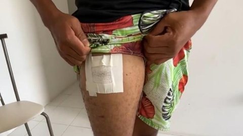 Homem fica ferido após explosão de celular no bolso - Imagem: reprodução