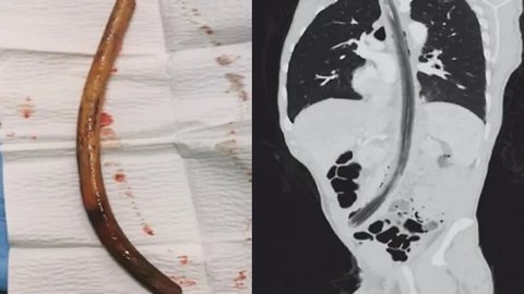 O pedaço de madeira foi removido do estômago do paciente por cirurgia - Imagem: divulgação/National Library of Medicine