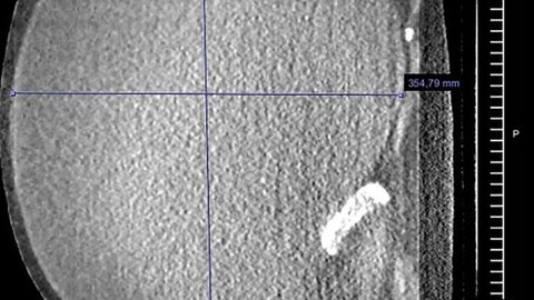 Scan de tomografia destaca o cisto 'gigante' no abdômen da paciente - Imagem: divulgação/American Journal of Case Reports