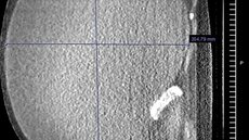 Scan de tomografia destaca o cisto 'gigante' no abdômen da paciente - Imagem: divulgação/American Journal of Case Reports