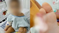 Bebê de 1 ano tem dedos decepados em creche de SP; veja o que aconteceu - Imagem: reprodução g1