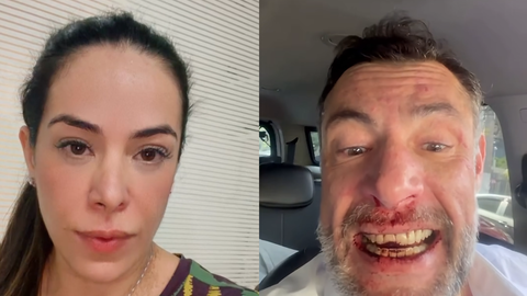Deputado Fernando Marangoni surge machucado após briga e caso expõe versões opostas - Imagem: Reprodução