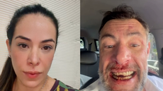 Deputado Fernando Marangoni surge machucado após briga e caso expõe versões opostas - Imagem: Reprodução