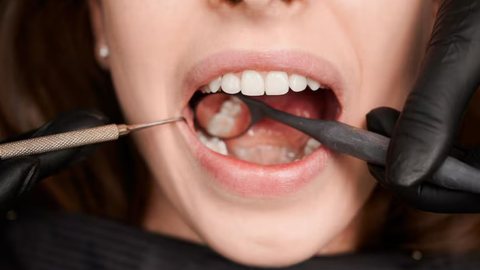 Com patentes registradas, a saliva artificial pode ser a solução para pacientes que enfrentam a perda de saliva devido à radioterapia - Imagem: Reprodução