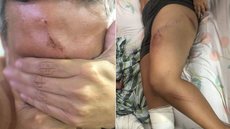 Três pessoas ficaram feridas após caírem dentro de cratera em São Vicente - Imagem: Reprodução/G1