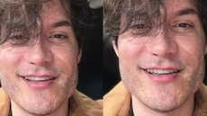 Eliezer desfaz harmonização facial e revela distorção de imagem; confira antes e depois - Imagem: Reprodução/ Instagram @Eliezer