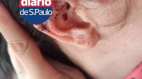 IMAGENS FORTES: homem arranca parte da orelha de namorada com mordida - Imagem: Reprodução/Polícia Civil