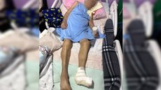 Idosa tem pé amputado em cirurgia clandestina no DF - Imagem: Reprodução