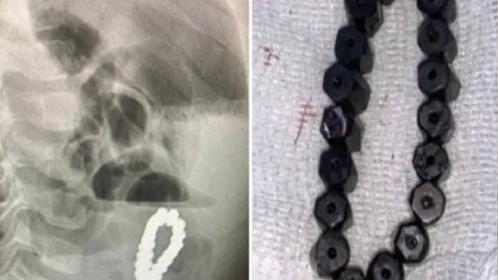 Menino engoliu bracelete e teve fortes dores abdominais e outros danos em seu intestino - Imagem: reprodução/New York Post