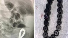 Menino engoliu bracelete e teve fortes dores abdominais e outros danos em seu intestino - Imagem: reprodução/New York Post