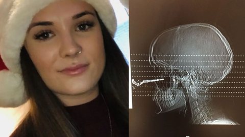 Uma jovem foi parar no hospital com uma chave de carro alojada no rosto. - Imagem: reprodução I The New York Post