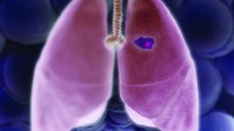 Mortalidade por câncer de pulmão entre mulheres deve aumentar em mais de 40% até 2030