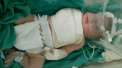 Bebê tem braço e clavícula quebrados durante parto em hospital público