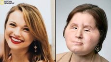 Antes e depois do transplante de rosto: paciente mais jovem da cirurgia experimental sonha ir para a faculdade