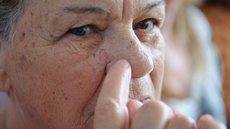 Ministério da Saúde abre consulta sobre diagnóstico do câncer de pele