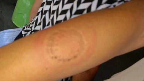 Professora é mordida no braço após pegar celular de aluna em Araçatuba
