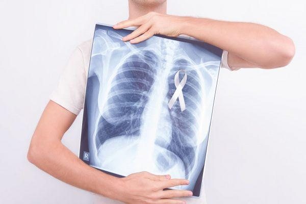 Tratamento de câncer avançado no pulmão exige análise molecular