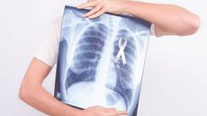 Tratamento de câncer avançado no pulmão exige análise molecular