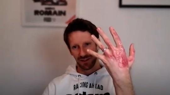 Romain Grosjean mostra mão queimada e fala sobre reabilitação: “É doloroso 23 horas por dia”