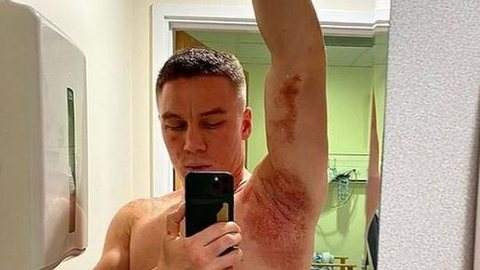 Campeão mundial de boxe sofre ataque com ácido durante assalto