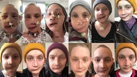 Após reconstrução facial, jovem fotografa o próprio rosto todos os dias para registrar recuperação
