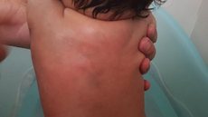 Mãe é acusada de agredir bebê de 5 meses nas costas e braços em Garça
