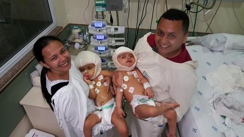HC divulga imagem de gêmeas após cirurgia de separação definitiva em Ribeirão Preto, SP