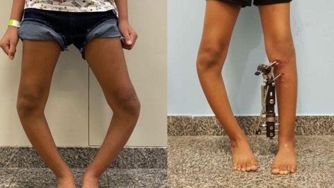 Técnica inovadora corrige deformidades nas pernas de crianças e jovens