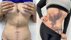 Tatuagens ressignificam cicatrizes de vítimas de violência doméstica e de cirurgias mal feitas