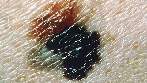 Taxa de mortalidade por melanoma aumentou em homens, diz estudo