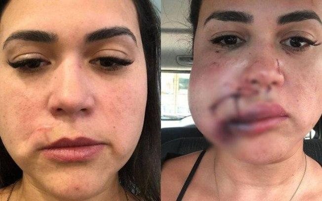 Mulher agredida em restaurante de luxo de São Paulo mostra reconstrução do rosto
