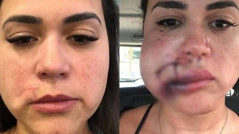 Mulher agredida em restaurante de luxo de São Paulo mostra reconstrução do rosto