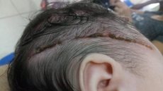 Recém-nascida leva 25 pontos na cabeça após ser cortada com bisturi durante parto, diz família