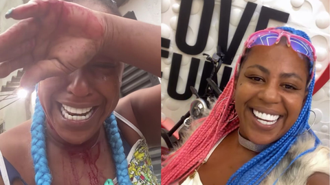 Cantora mostrou ferimentos na cabeça e disse que precisou levar pontos - Imagem: Reprodução | Redes Sociais